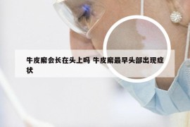 牛皮廨会长在头上吗 牛皮廨最早头部出现症状