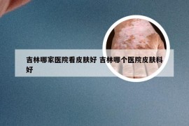 吉林哪家医院看皮肤好 吉林哪个医院皮肤科好