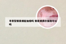 寻常型银屑病能抽烟吗 银屑病偶尔抽烟可以吗