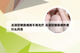 点滴型银屑病用不用光疗 点滴型银屑病外用什么药膏