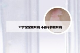 12岁宝宝银屑病 小孩子得银屑病