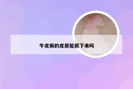 牛皮癣的皮屑能抓下来吗