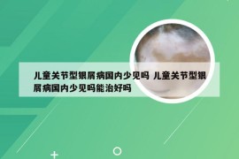 儿童关节型银屑病国内少见吗 儿童关节型银屑病国内少见吗能治好吗