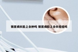 银屑病长脸上会肿吗 银屑病脸上会长痘痘吗