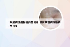 银屑病慢病报销药品目录 银屑病慢病报销药品目录