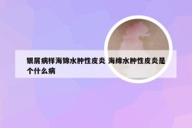 银屑病样海锦水肿性皮炎 海绵水肿性皮炎是个什么病