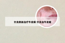 针灸刺血治疗牛皮癣 针灸治牛皮廨