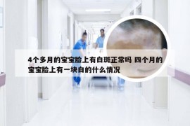 4个多月的宝宝脸上有白斑正常吗 四个月的宝宝脸上有一块白的什么情况