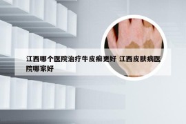 江西哪个医院治疗牛皮癣更好 江西皮肤病医院哪家好