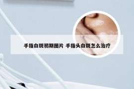 手指白斑初期图片 手指头白斑怎么治疗