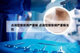 点滴型银屑病严重嘛 点滴型银屑病严重嘛女性