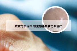 皮肤怎么治疗 螨虫感染皮肤怎么治疗