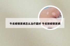 牛皮癣银屑病怎么治疗最好 牛皮肤癣银屑病