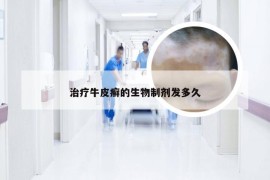 治疗牛皮癣的生物制剂发多久