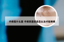 手癣是什么菌 手癣真菌感染怎么治才能断根