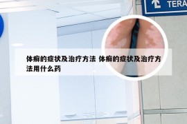 体癣的症状及治疗方法 体癣的症状及治疗方法用什么药