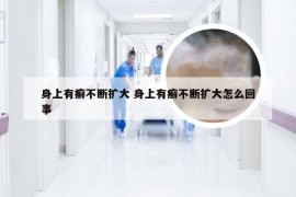 身上有癣不断扩大 身上有癣不断扩大怎么回事