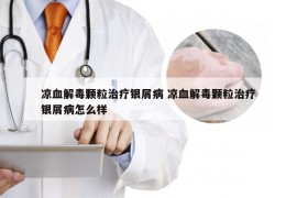 凉血解毒颗粒治疗银屑病 凉血解毒颗粒治疗银屑病怎么样