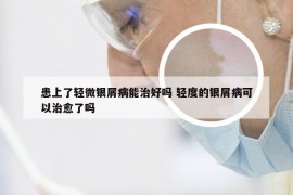 患上了轻微银屑病能治好吗 轻度的银屑病可以治愈了吗