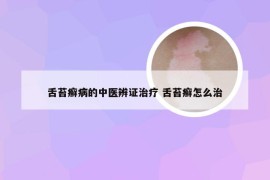 舌苔癣病的中医辨证治疗 舌苔癣怎么治