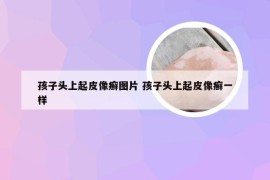 孩子头上起皮像癣图片 孩子头上起皮像癣一样