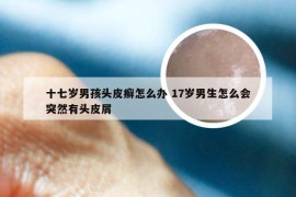 十七岁男孩头皮癣怎么办 17岁男生怎么会突然有头皮屑