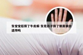 生宝宝后得了牛皮癣 生完孩子得了银屑病会遗传吗