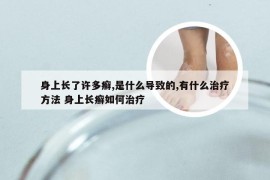 身上长了许多癣,是什么导致的,有什么治疗方法 身上长癣如何治疗