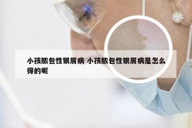 小孩脓包性银屑病 小孩脓包性银屑病是怎么得的呢