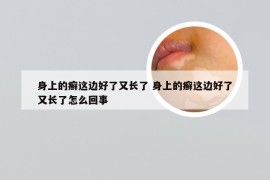 身上的癣这边好了又长了 身上的癣这边好了又长了怎么回事