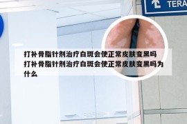 打补骨脂针剂治疗白斑会使正常皮肤变黑吗 打补骨脂针剂治疗白斑会使正常皮肤变黑吗为什么