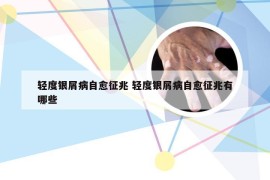 轻度银屑病自愈征兆 轻度银屑病自愈征兆有哪些