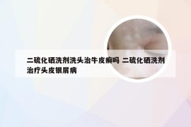 二硫化硒洗剂洗头治牛皮癣吗 二硫化硒洗剂治疗头皮银屑病