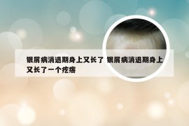 银屑病消退期身上又长了 银屑病消退期身上又长了一个疙瘩