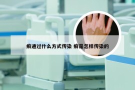 癣通过什么方式传染 癣是怎样传染的