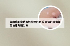 白斑病的症状如何快速判断 白斑病的症状如何快速判断出来