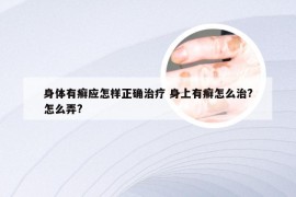 身体有癣应怎样正确治疗 身上有癣怎么治?怎么弄?