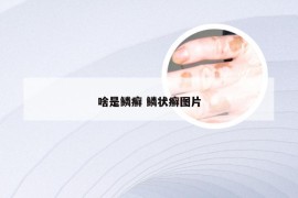 啥是鳞癣 鳞状癣图片