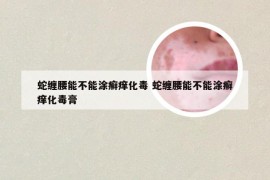 蛇缠腰能不能涂癣痒化毒 蛇缠腰能不能涂癣痒化毒膏