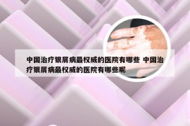 中国治疗银屑病最权威的医院有哪些 中国治疗银屑病最权威的医院有哪些呢