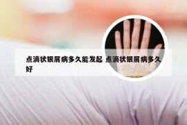 点滴状银屑病多久能发起 点滴状银屑病多久好