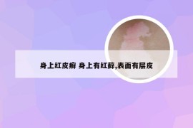 身上红皮癣 身上有红藓,表面有层皮