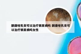 酮康唑乳膏可以治疗银屑病吗 酮康唑乳膏可以治疗银屑病吗女性