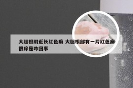 大腿根附近长红色癣 大腿根部有一片红色癣很痒是咋回事