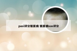 pasi评分银屑病 银屑病vas评分