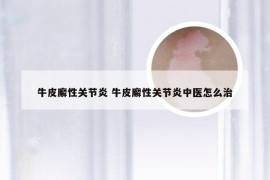 牛皮廨性关节炎 牛皮廨性关节炎中医怎么治