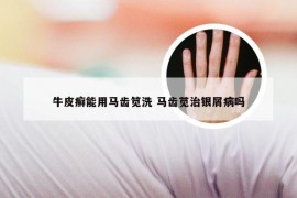 牛皮癣能用马齿笕洗 马齿苋治银屑病吗