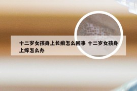 十二岁女孩身上长癣怎么回事 十二岁女孩身上痒怎么办