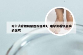 哈尔滨看银屑病医院哪家好 哈尔滨看银屑病的医院