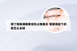 得了银屑病哪里有伤口哪里长 银屑病留下的疤怎么去掉